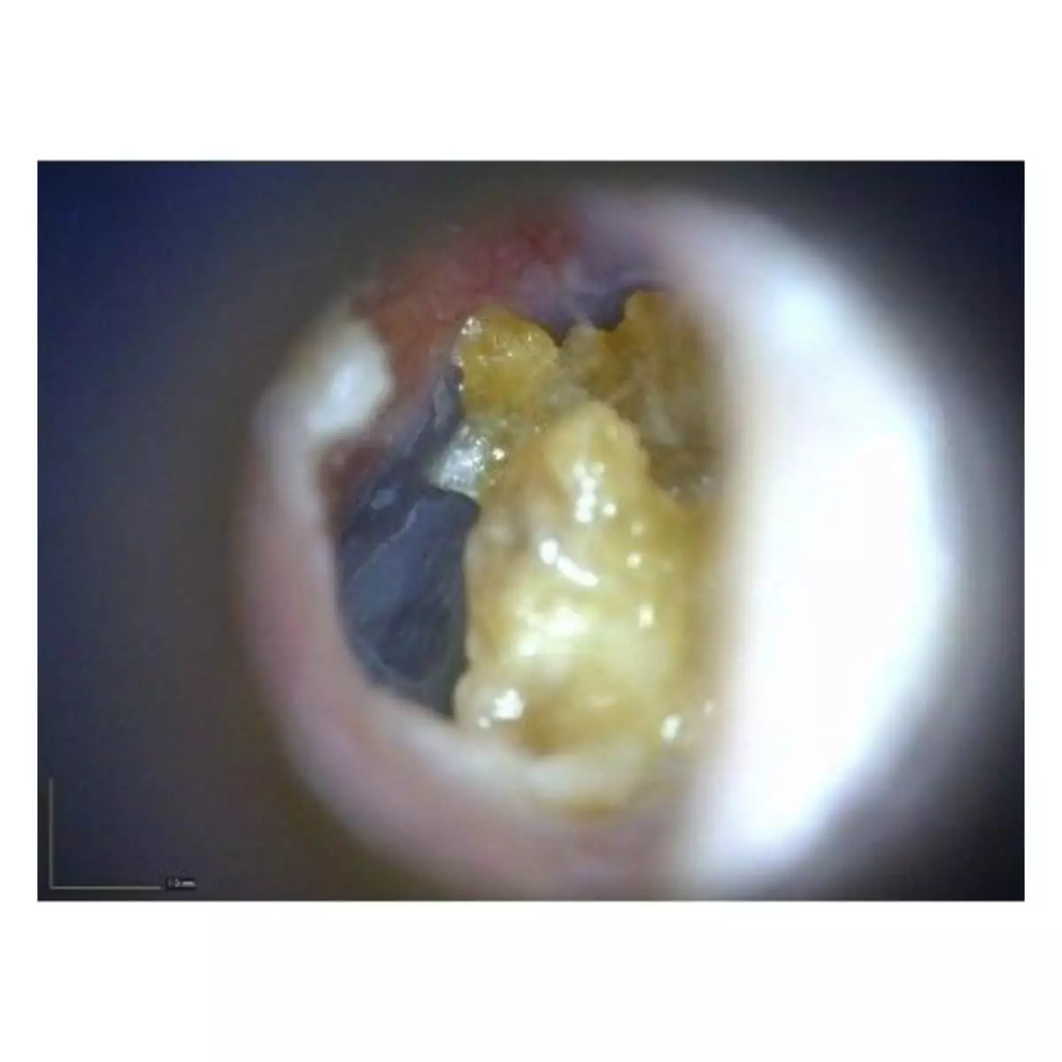  Otoscope vidéo sans fil EarScope Pro
