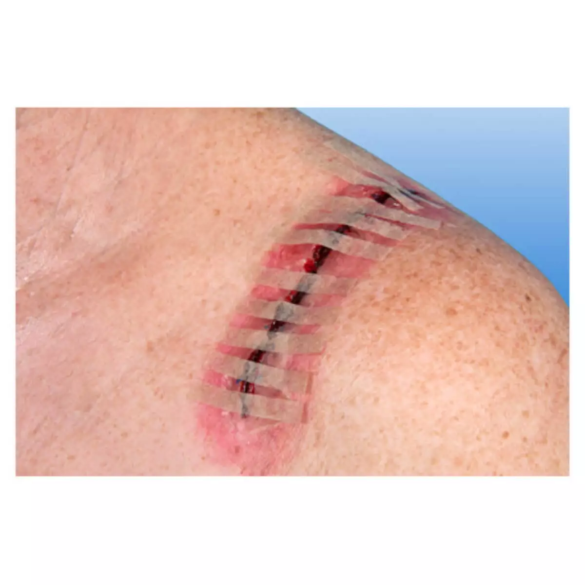  Sutures adhésives stériles RUDANAHT