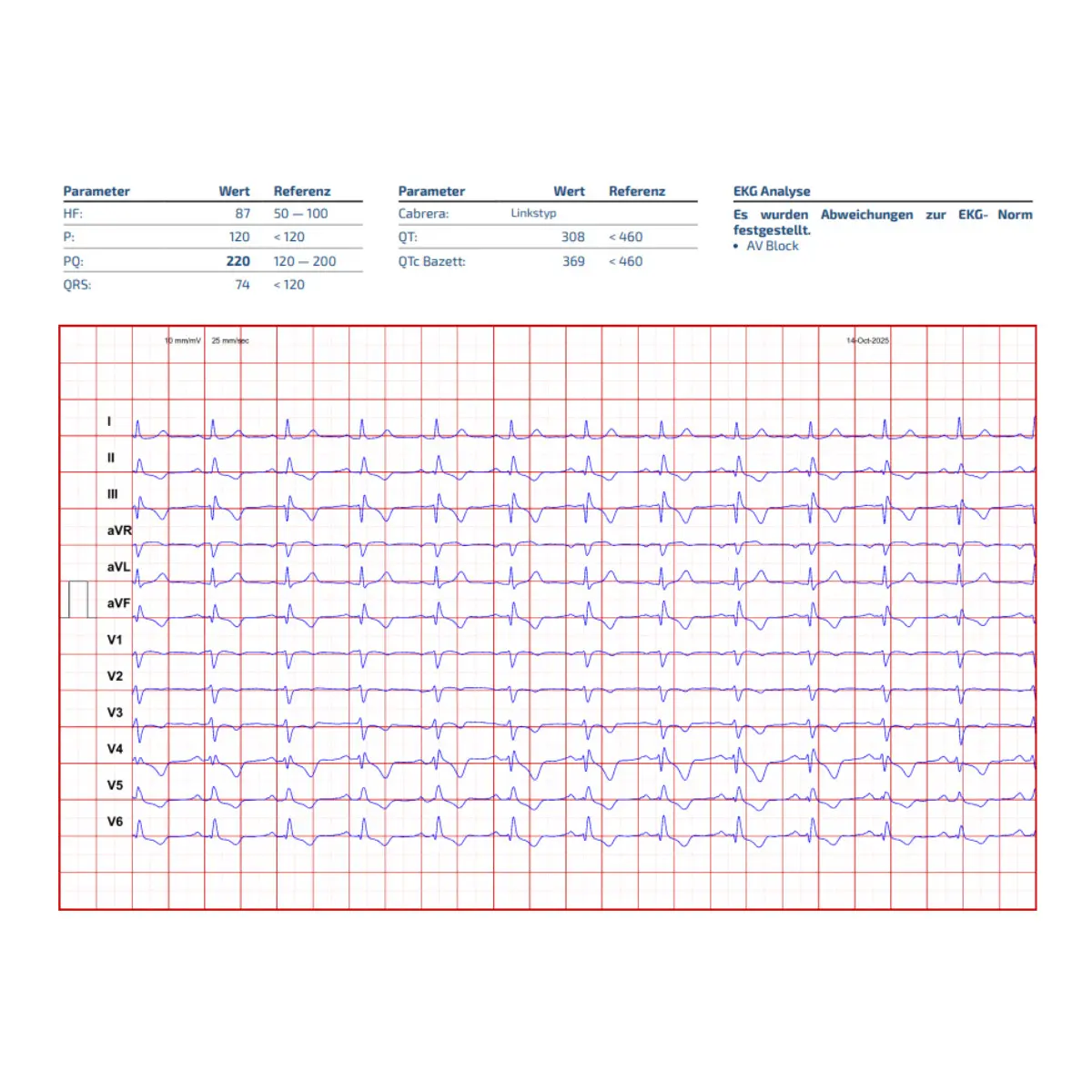 ECG 3D basé sur l'IA Cardisio  ECG 3D basé sur l'IA Cardisio