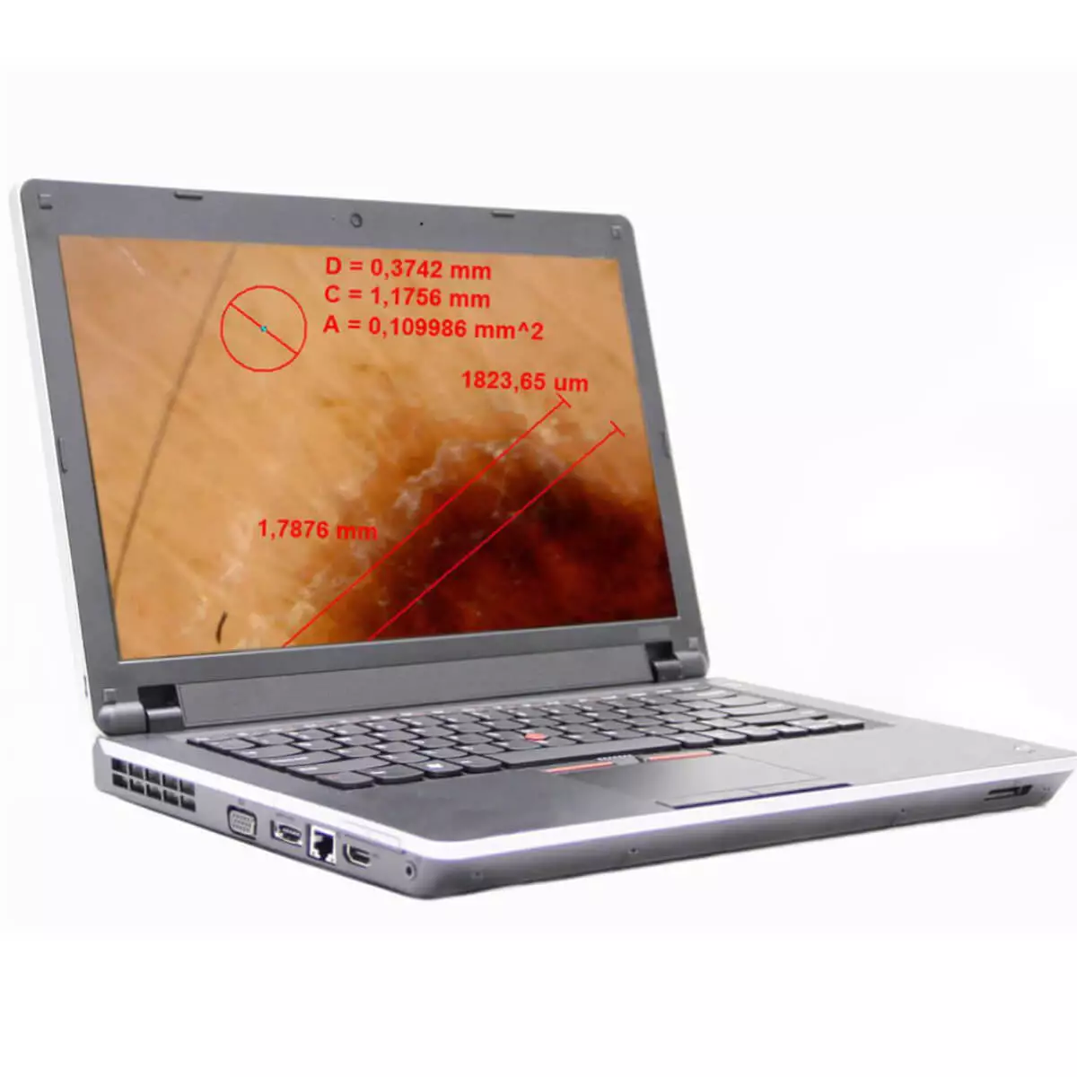  Dermatoscope vidéo sans fil DermaScope Polarizer