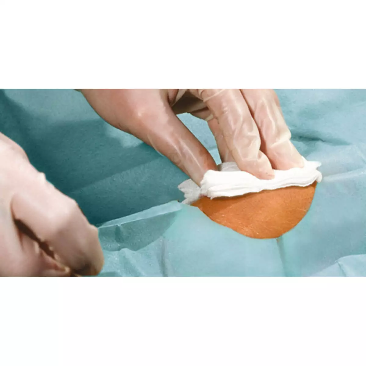  Champ chirurgical troué auto-adhésif Foliodrape Protect