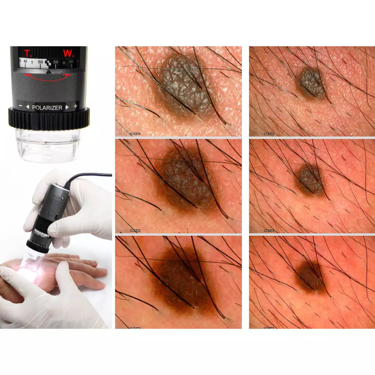  Dermatoscope vidéo DermaScope Polarizer HR 200x